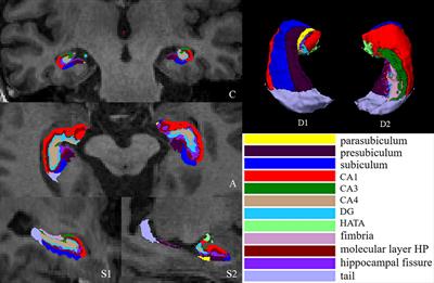 Relationships Between Memory Impairments and Hippocampal Structure in Patients With Subcortical Ischemic Vascular Disease